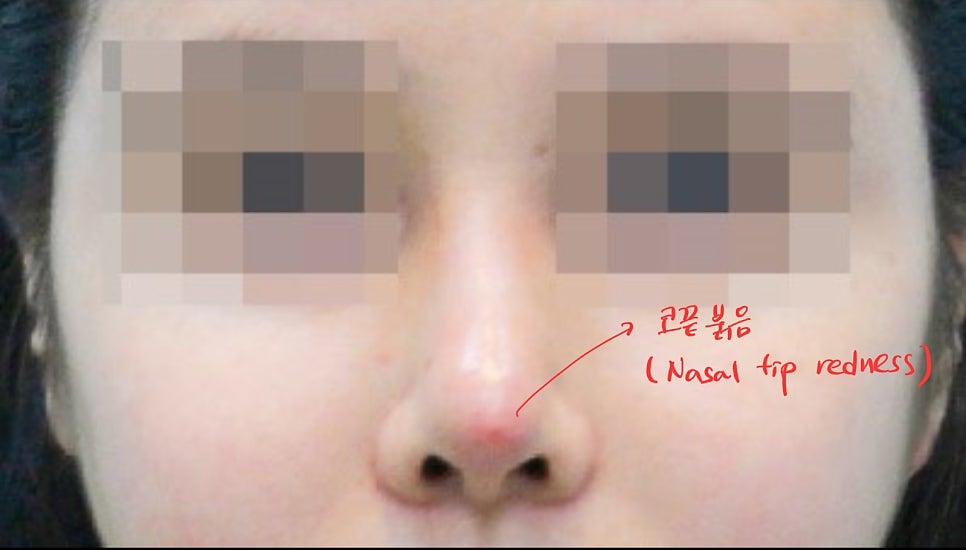 Nasal Tip Skin Irritation Caused by L-Shaped Silicone image 1