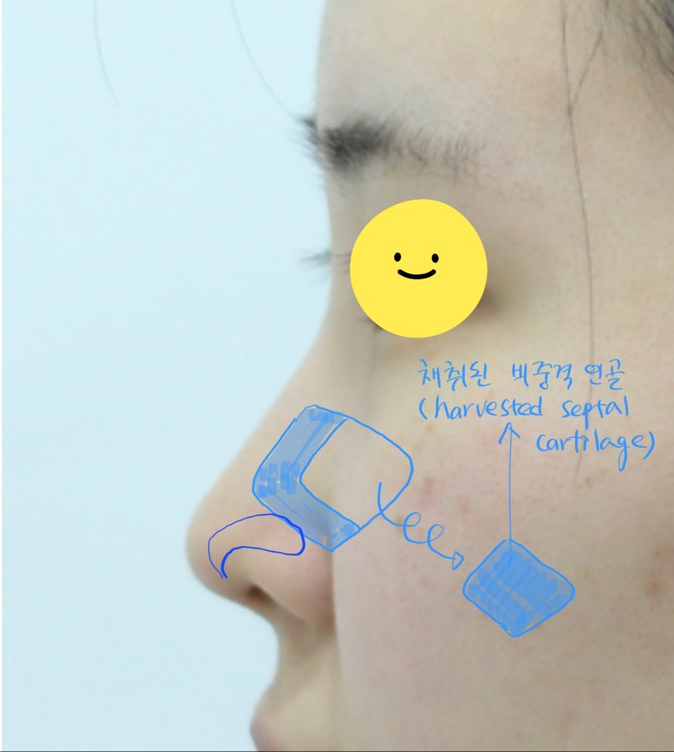코성형에서 비중격 연골과 귀연골의 용도 관련 이미지 3