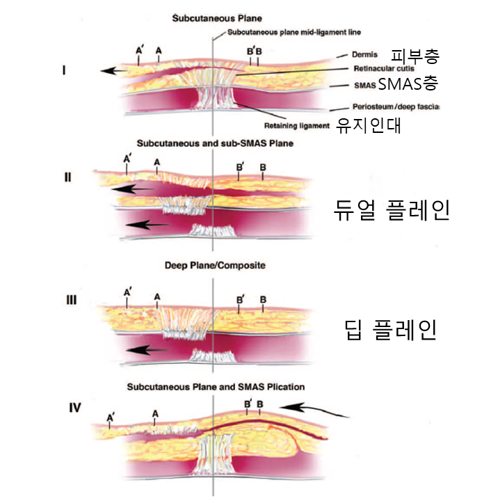안면거상 재수술에서 수술 방법의 선택 관련 이미지 4