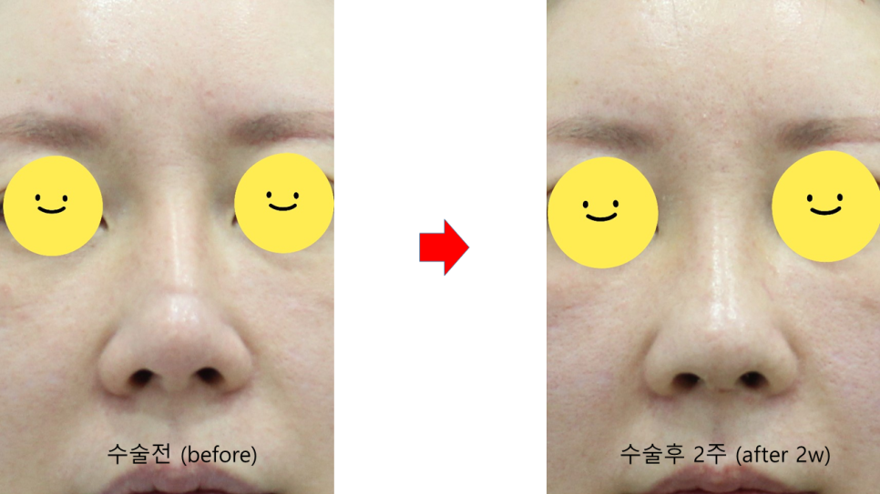 콧대에 실리콘 보형물을 늑연골로 대체하는 경우 관련 이미지 7