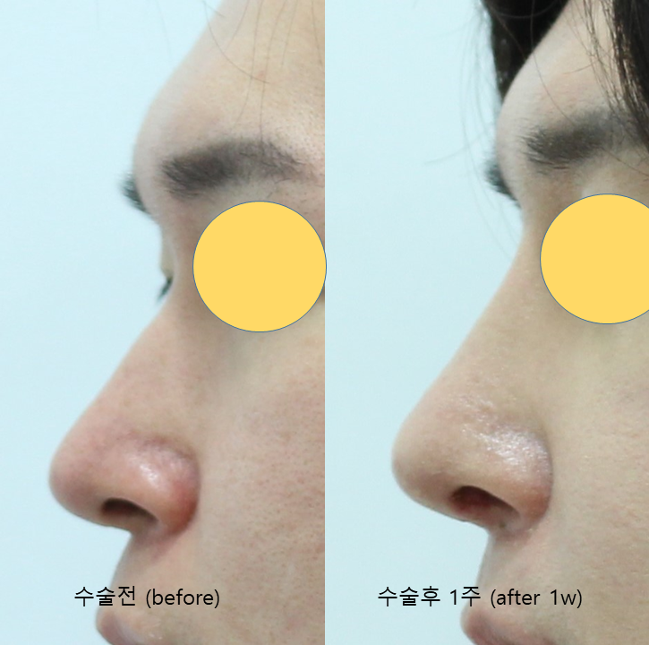 Male Rhinoplasty Performed Alongside Septoplasty image 8