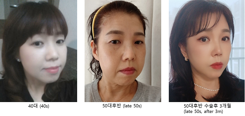 중년종합성형 상담과 수술의 범위 관련 이미지 8