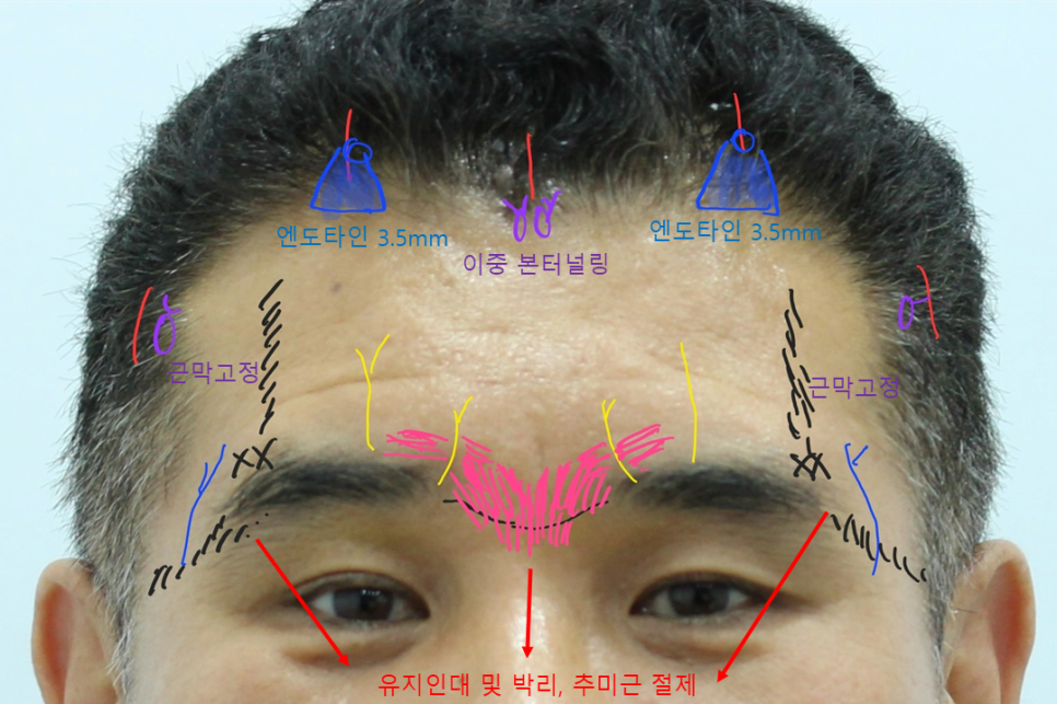 중년 남자 이마거상 수술의 과정 관련 이미지 2
