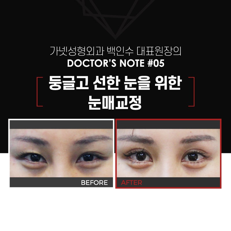 【Garnet Plastic Surgery Director Baek In-soo’s Plastic Surgery Column】 Eye Correction for a Rounder, Kinder Eye Shape image 2