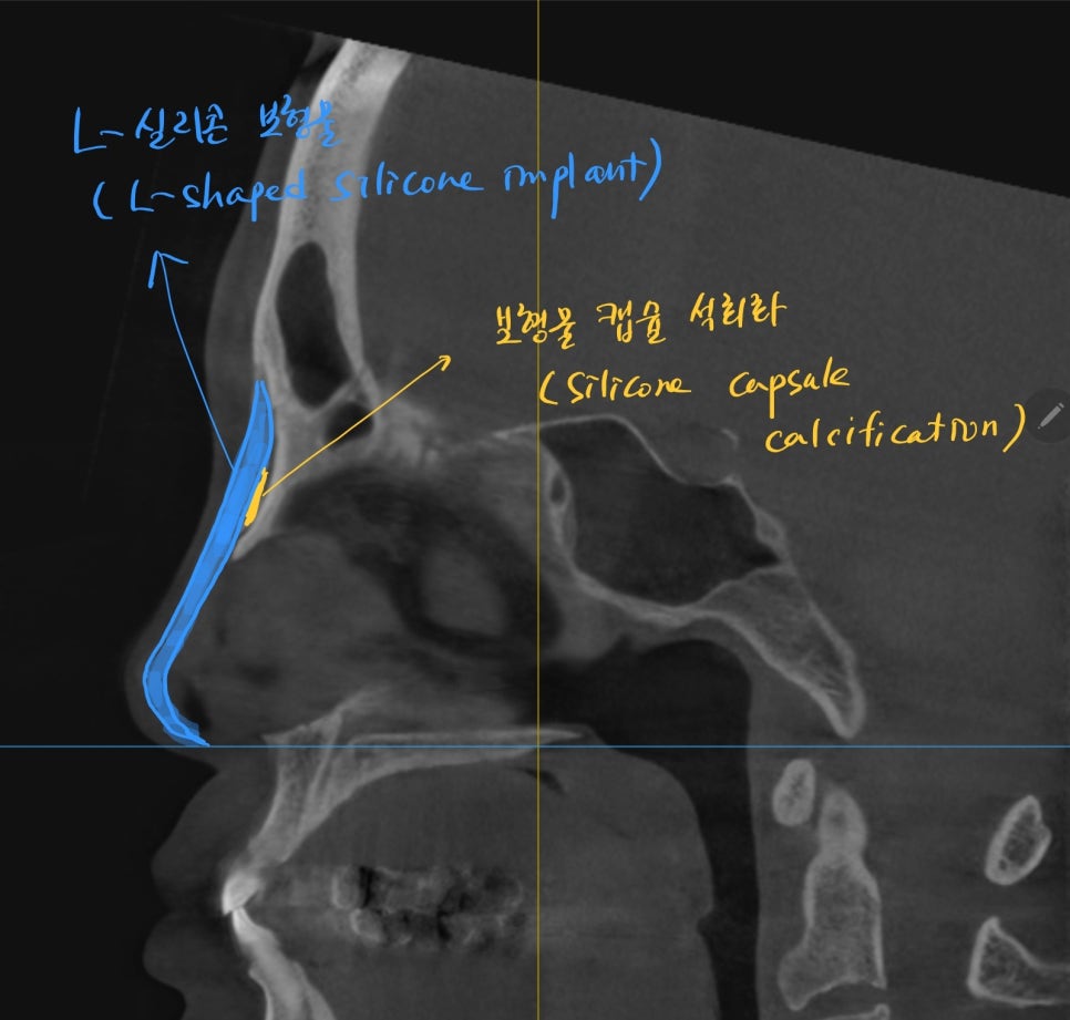 Use of Rib Cartilage in Midlife Rhinoplasty image 2