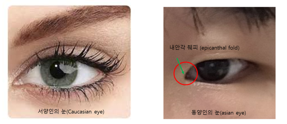 앞트임 재수술에서 윗트임의 중요성 관련 이미지 1