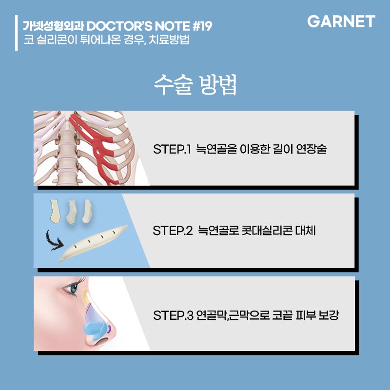 [가넷성형외과 백인수원장 성형칼럼] 코 실리콘이 튀어나온 경우, 치료방법 관련 이미지 4