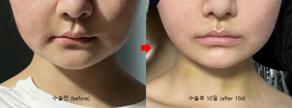 앞볼 지방과 심부볼 지방을 리프팅하는 딥미니거상 관련 이미지 7