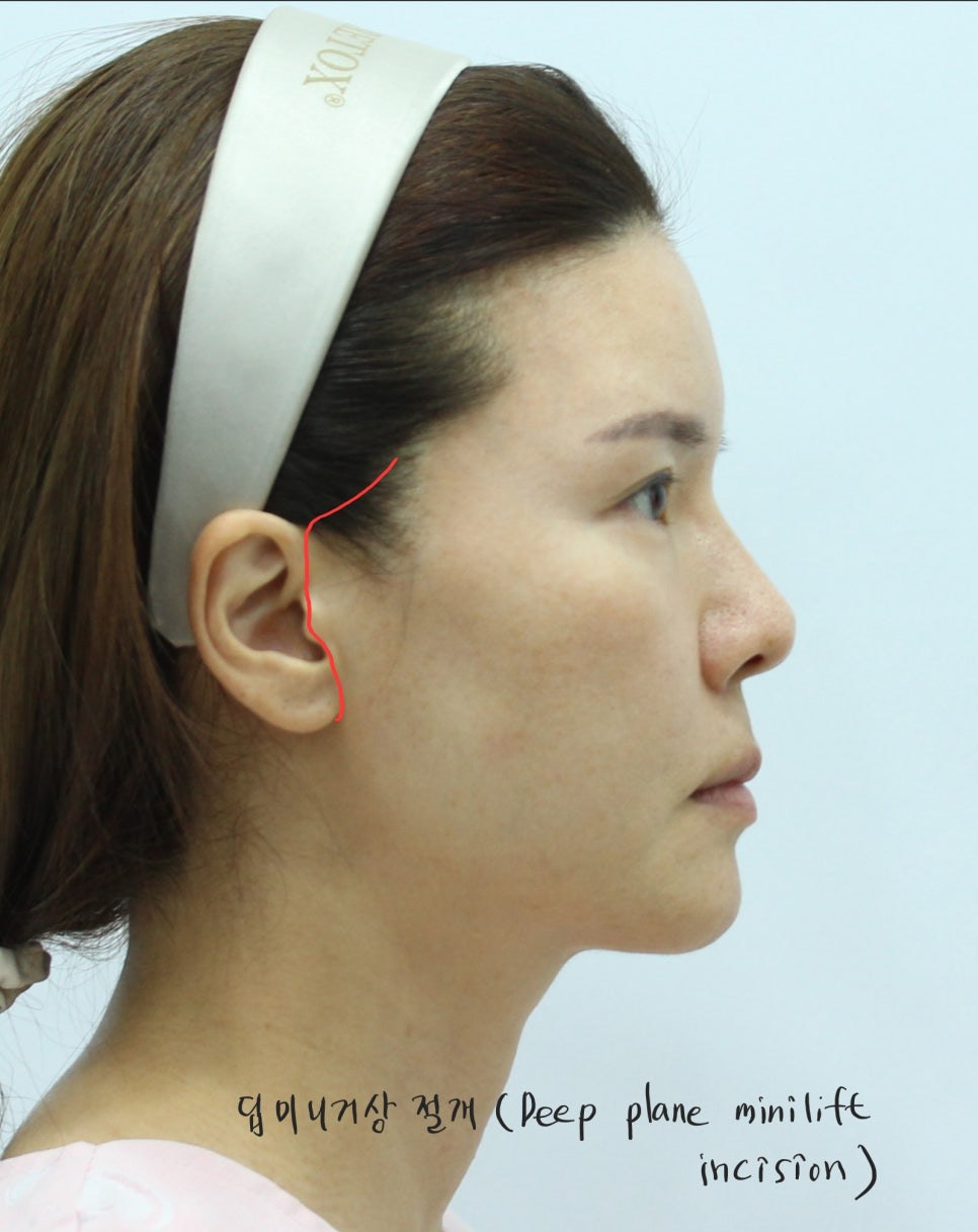 Correcting Cheek Sagging and Sunken Cheeks After Facial Contouring Surgery image 3