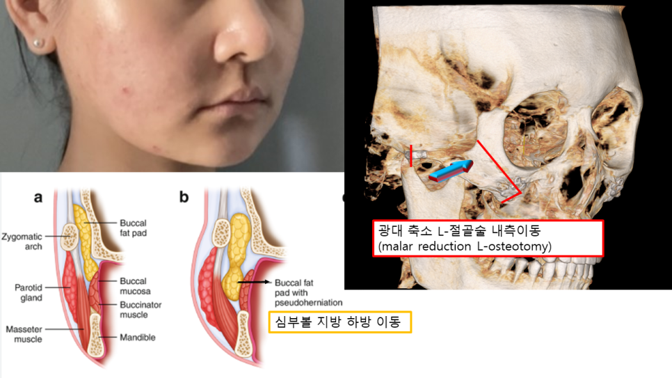 광대축소술 후 볼처짐과 미니거상, 흉터 부담은 줄이고 자연스럽게 관련 이미지 1