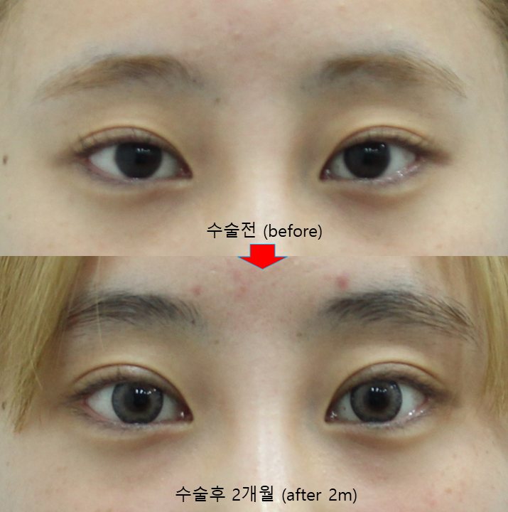 Non-incisional Eye Correction in Revision Surgery for Buried-Method Double Eyelids image 12