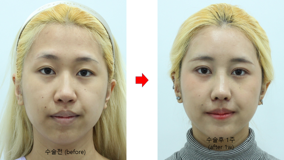 첫번째 코성형, 첫코성형, 20대 코성형 관련 이미지 9