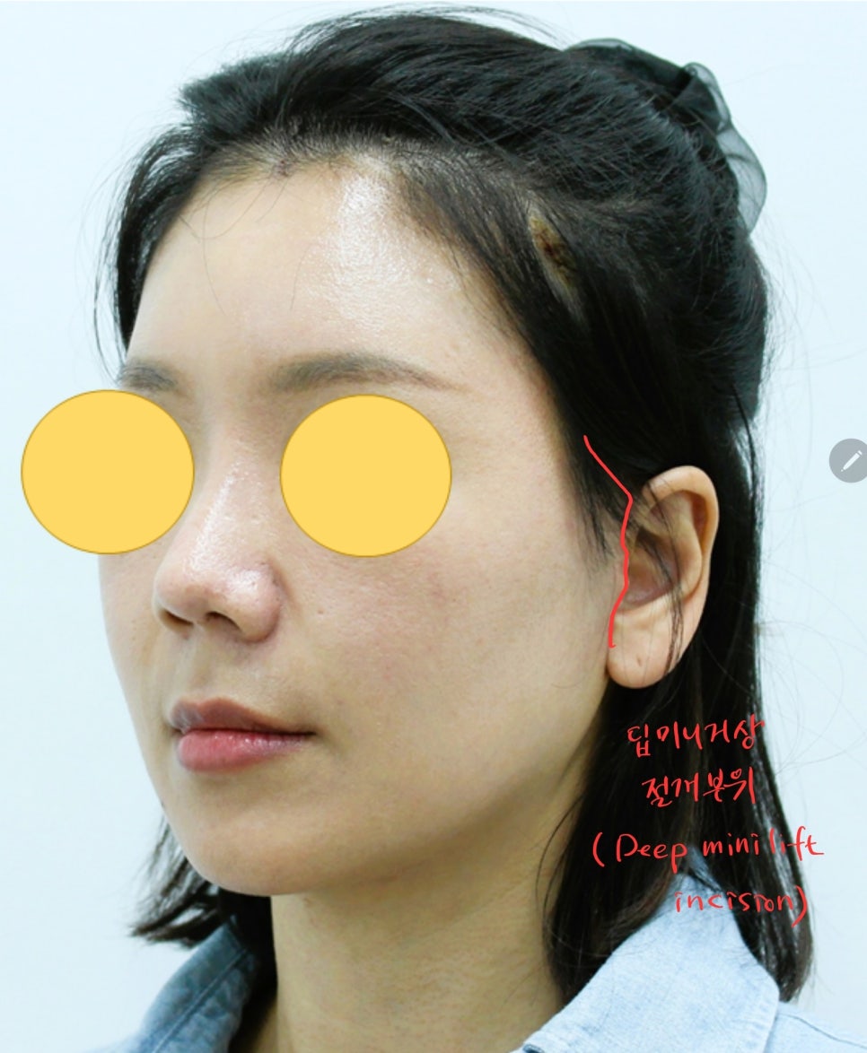 Areas of the Face Improved by a Deep Mini Facelift image 3