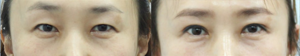 Choosing a Surgical Method for Upper Eyelid Skin Sagging image 6