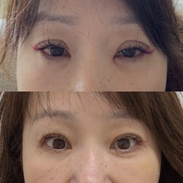 중년눈성형에서 눈매교정이 필요한 경우 관련 이미지 6