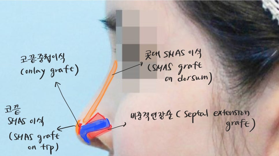 Nasal Tip Skin Irritation Caused by L-Shaped Silicone image 6