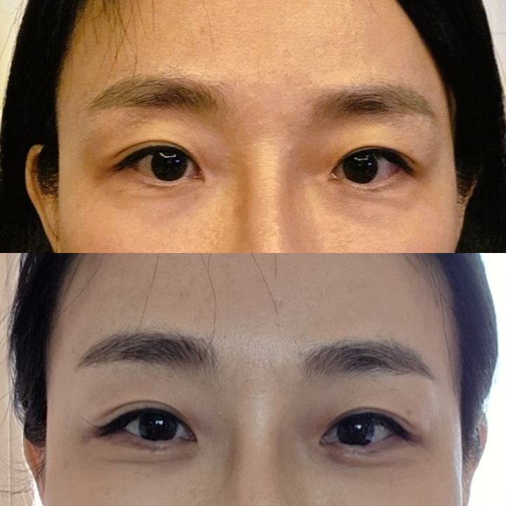 애교살을 보존하는 하안검수술, 무엇이 다를까? 관련 이미지 5