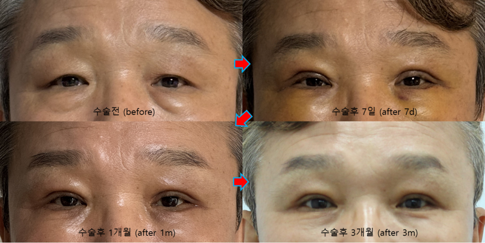 Recovery Process and Natural Impression Changes After Upper and Lower Eyelid Surgery in a Man in His 50s image 3
