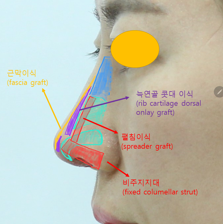 고어텍스 보형물을 자가조직으로 교체하는 코성형 관련 이미지 5