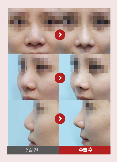 【가넷성형외과 백인수원장 성형칼럼】 코필러제거 후 코수술 케이스 관련 이미지 6
