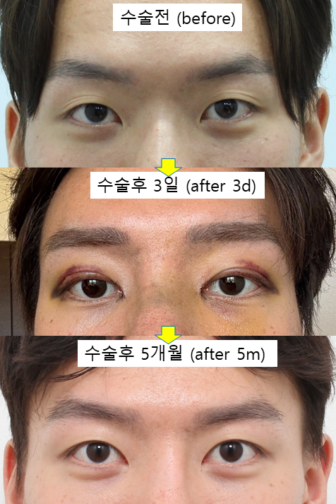 남자 비절개 쌍꺼풀과 눈매교정, 자연스러운 속쌍꺼풀을 원한다면 관련 이미지 2