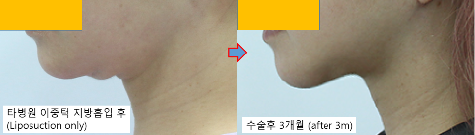 The Evolution of Double-Chin Surgery: From Liposuction to Pelican Surgery image 3