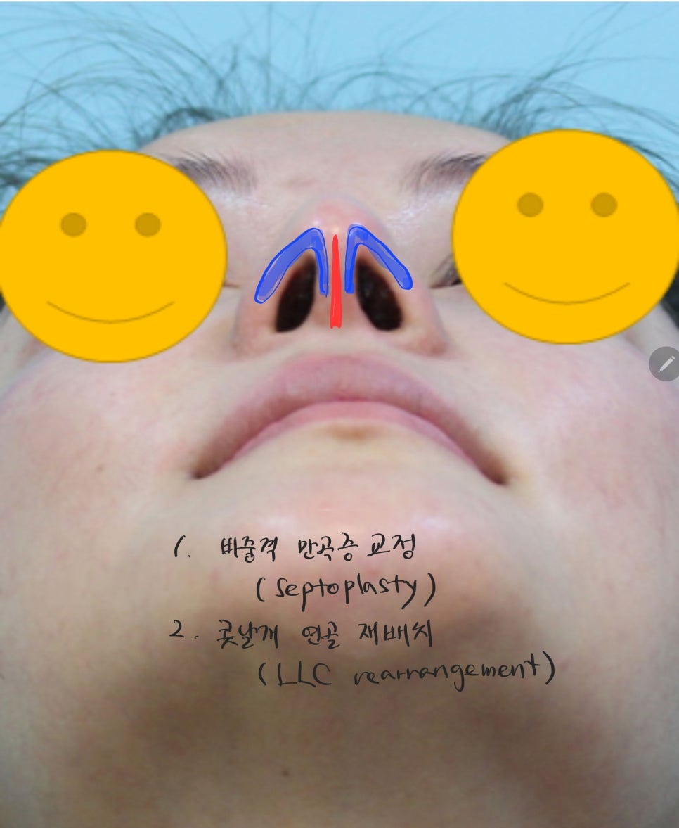 안면비대칭에서 코성형의 중요성 관련 이미지 5