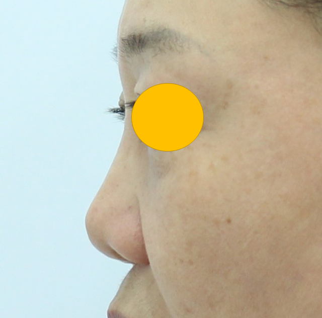 Use of Rib Cartilage in Midlife Rhinoplasty image 1