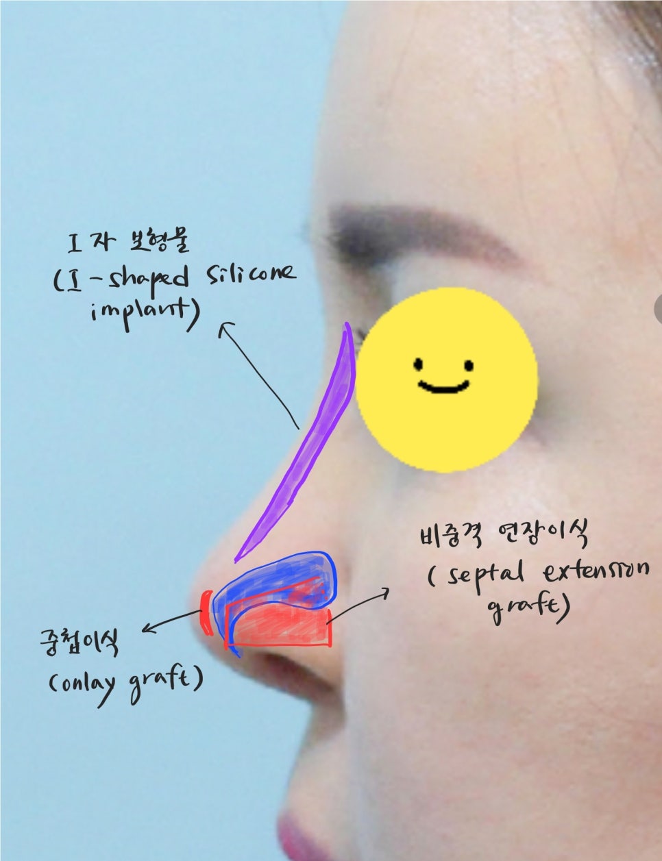 트렌드 변화에 따른 중년코 재수술 관련 이미지 4