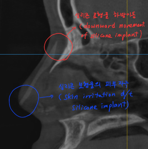 Information You Can Obtain Through CT Scanning During a Consultation for Revision Rhinoplasty image 3