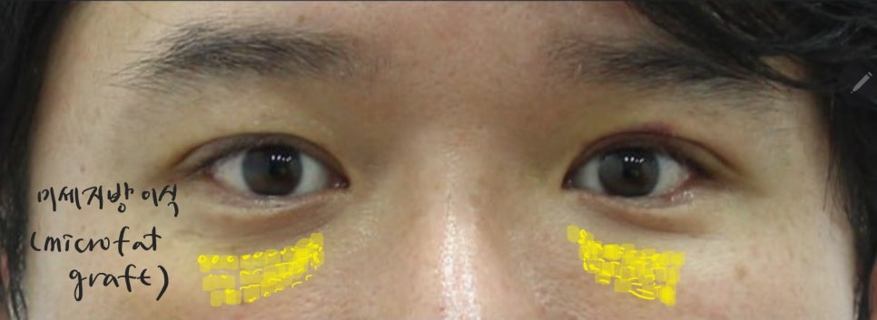 Types of Under-Eye Hollowness and Correction Methods image 7