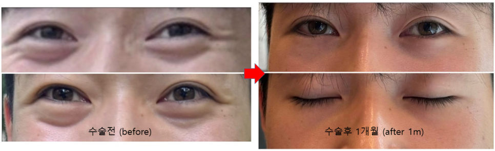 Types of Under-Eye Hollowness and Correction Methods image 5