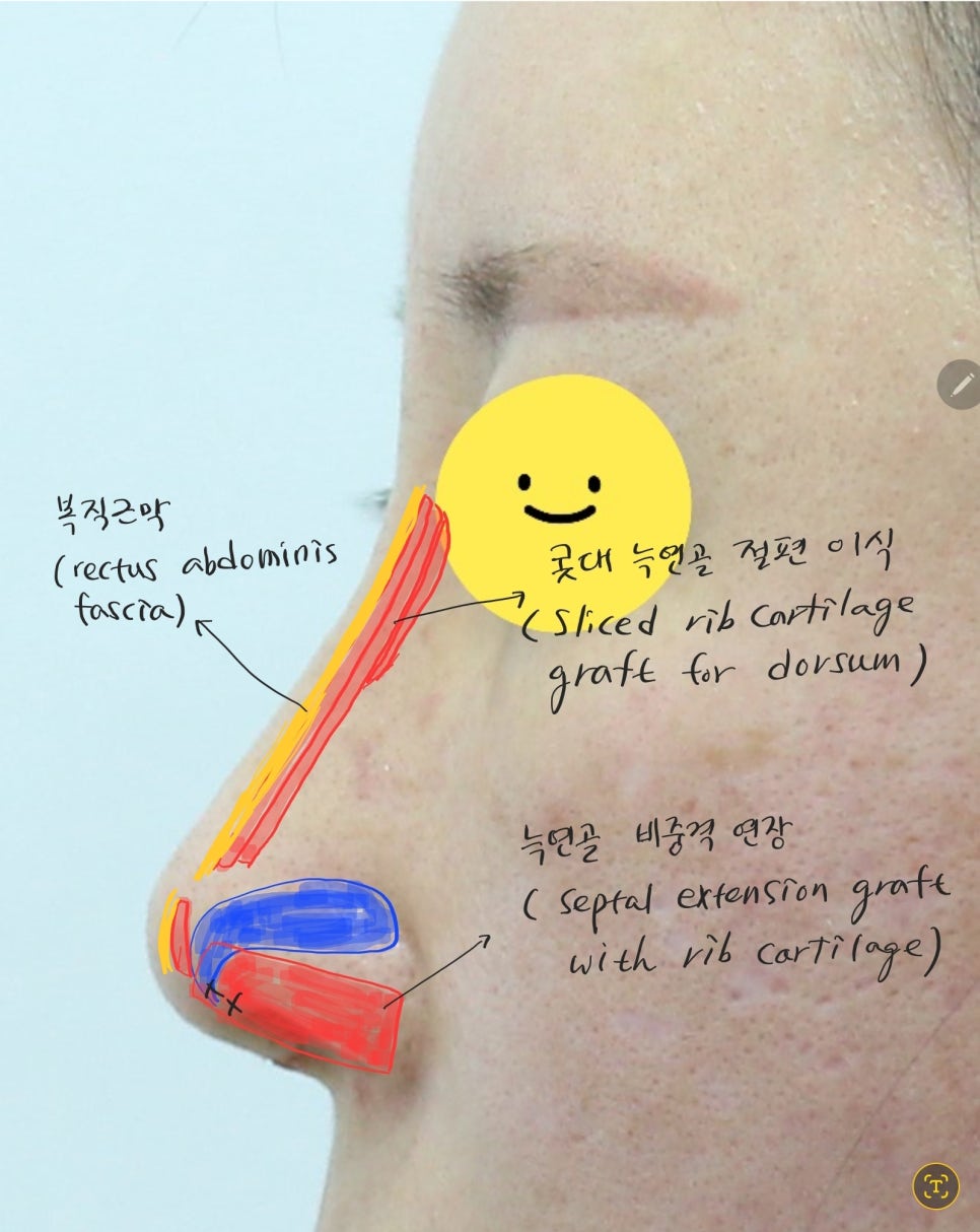 콧대에 실리콘 보형물을 늑연골로 대체하는 경우 관련 이미지 6