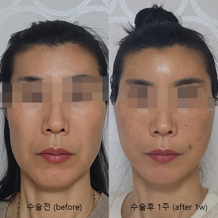 How a Facelift Changes Face Shape image 6