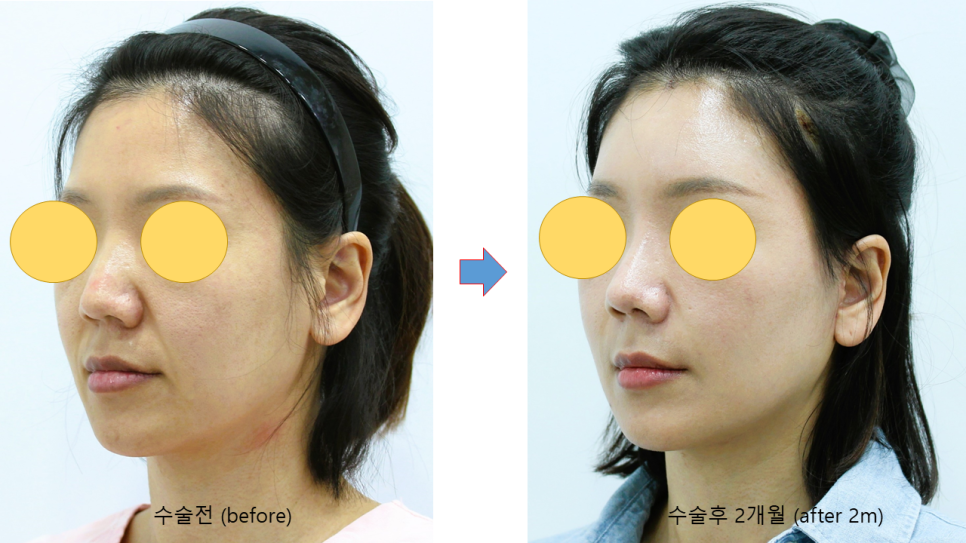 Areas of the Face Improved by a Deep Mini Facelift image 8