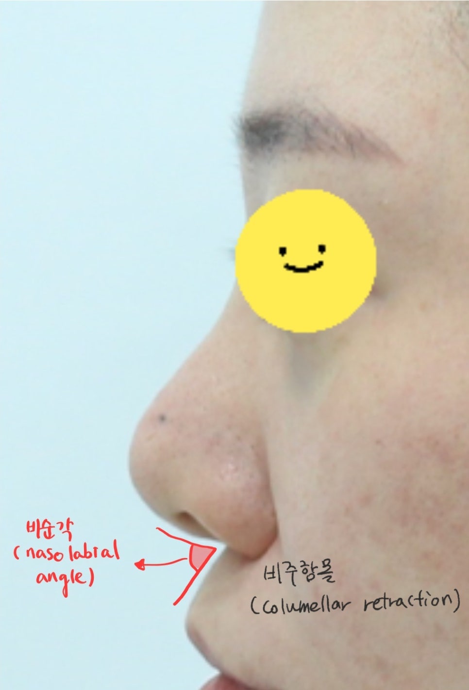 늑연골을 이용한 비주함몰의 교정 관련 이미지 4