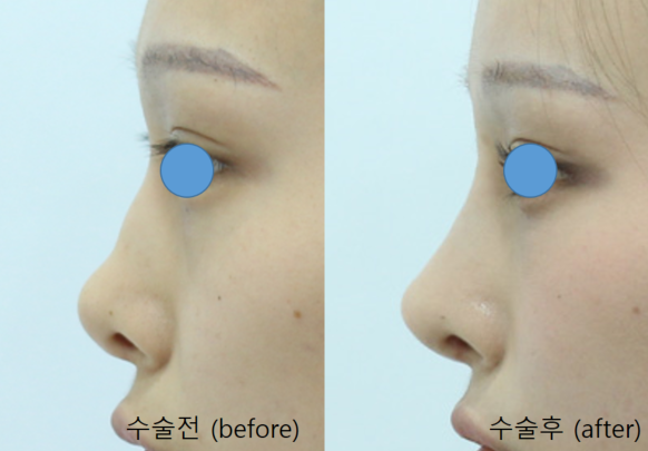 Rib Cartilage Rhinoplasty for a Deviated Saddle Nose image 13