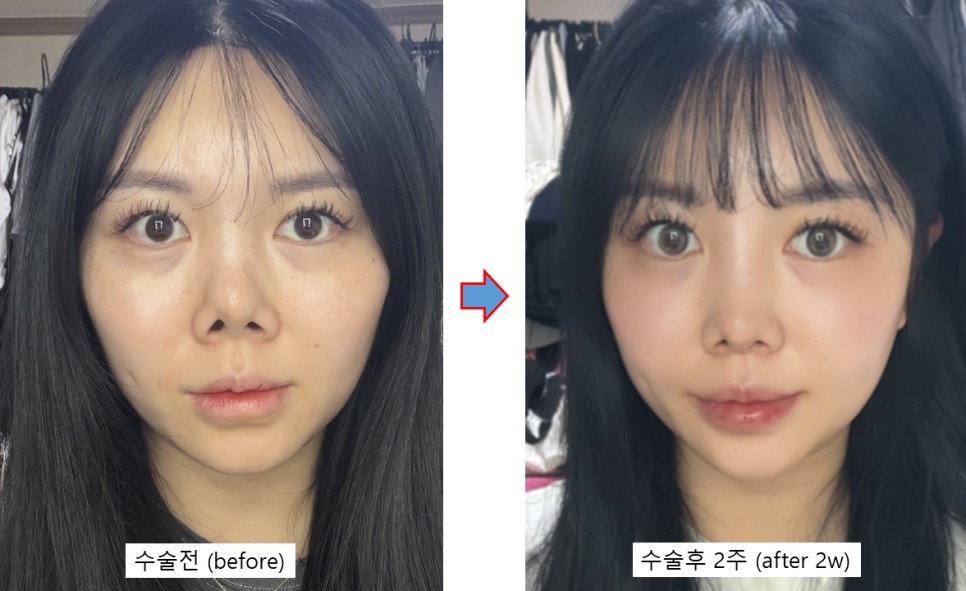 늑연골로 만든 콧대, 정말 흡수될까요? 관련 이미지 7