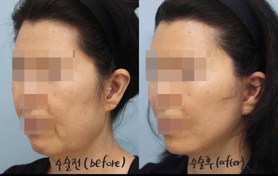 Dissection Range in Facelift Surgery image 6