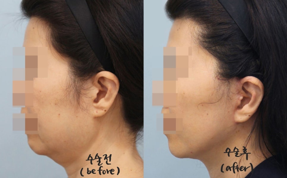 Dissection Range in Facelift Surgery image 7