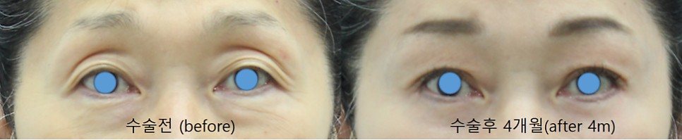 Upper Eyelid Surgery with Upper Eyelid Fat Repositioning image 6