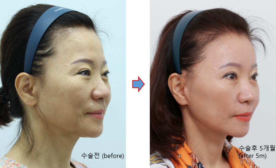 After a Face Lift, When Will Swelling and Bruising Go Away? Recovery Process and Natural Results image 6