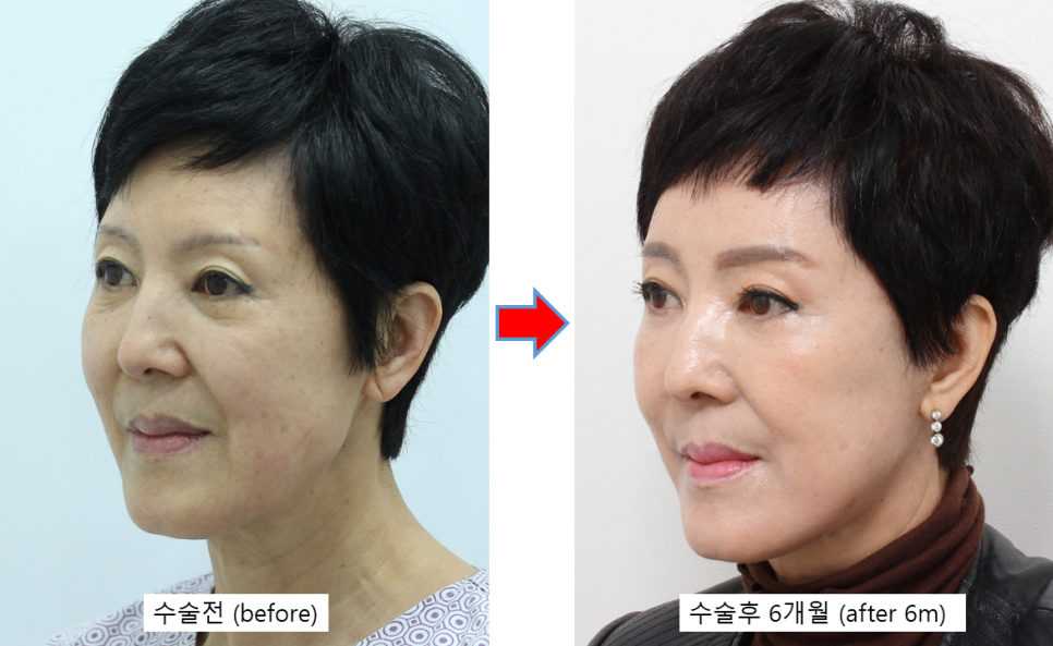 자연스러운 안면거상의 최종결과 관련 이미지 2