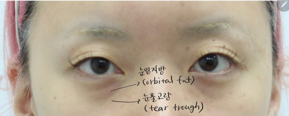 눈밑지방재배치의 회복기간 관련 이미지 1