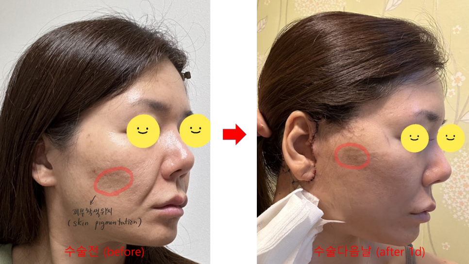 Swelling the Day After a Facelift image 6