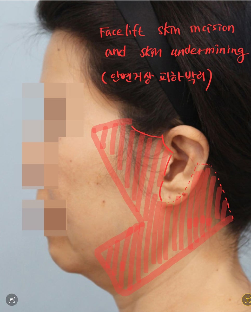 Dissection Range in Facelift Surgery image 2