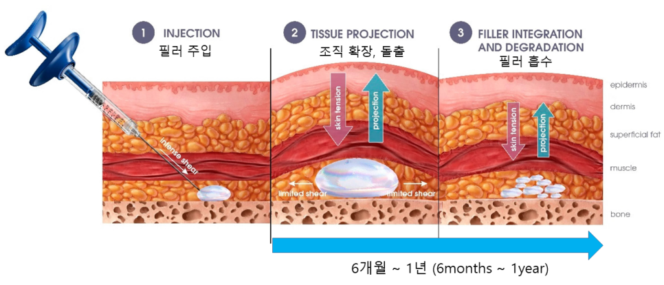 이영지 눈밑지방재배치, 시술일까 수술일까? 관련 이미지 5