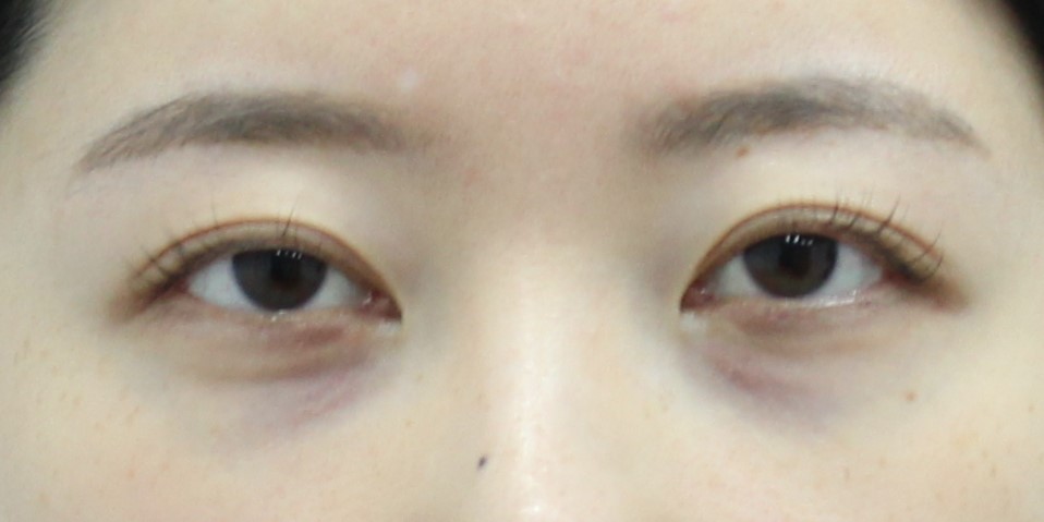Non-incisional Eye Correction in Revision Surgery for Buried-Method Double Eyelids image 7