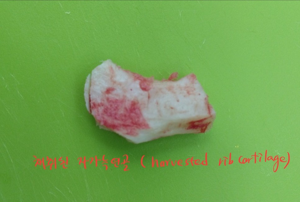 Rib Cartilage Nose Revision Surgery for Bird Beak Deformity image 5