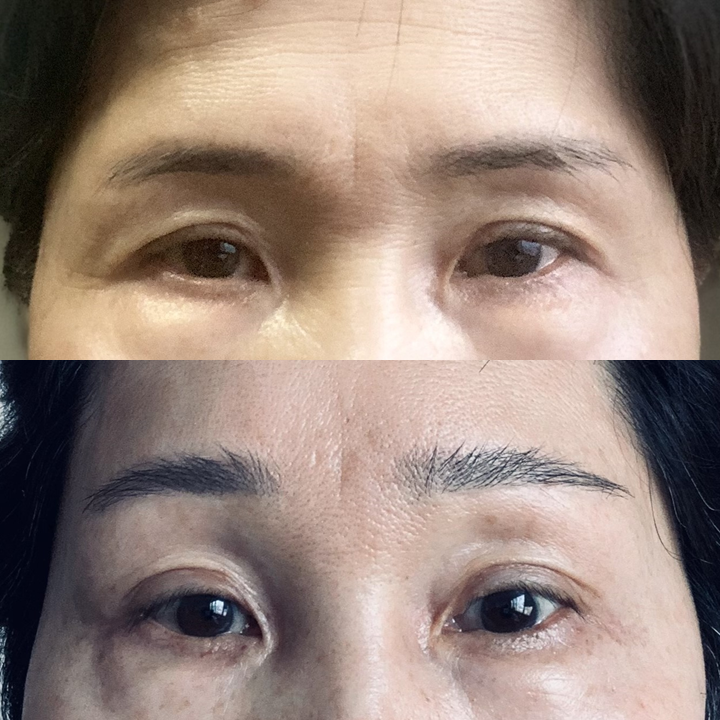 이마거상술 고정법, 엔도타인과 실고정 중 무엇이 더 좋을까요? 관련 이미지 5